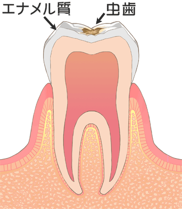 C1（軽度）虫歯
